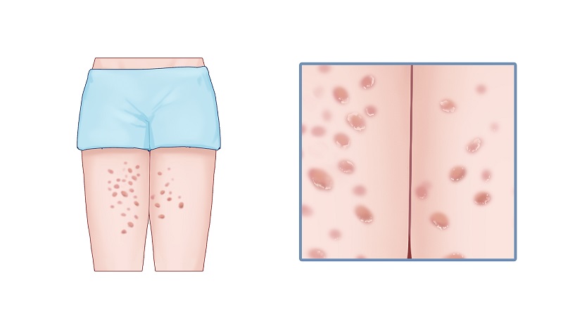 早期梅毒怎么治疗有效