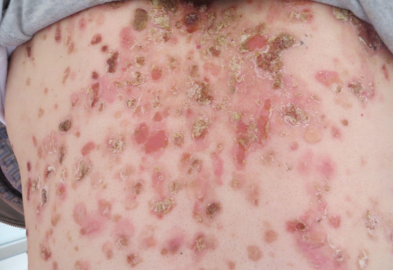 淋病疾病会引发什么危害呢